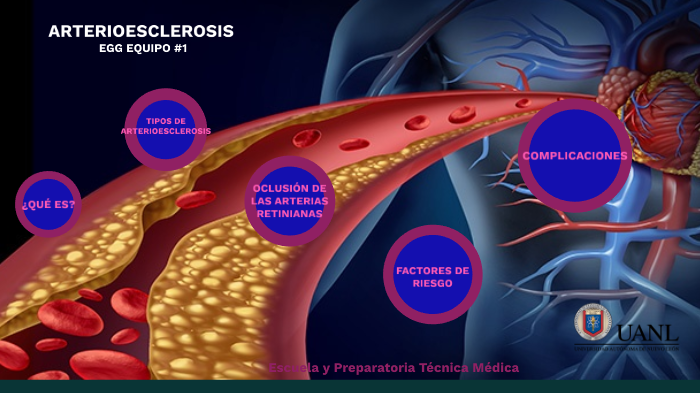 Arterioesclerosis By Ana Niño On Prezi