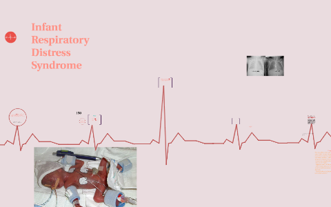 Infant Respiratory Distress Syndrome by Kayla Johnston on Prezi