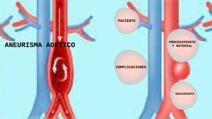 ANEURISMA AORTICA INFRARRENAL by PAOLA CORREDOR P on Prezi