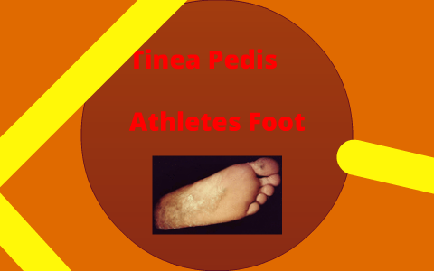 Athletes Foot by Aaron Gottfried