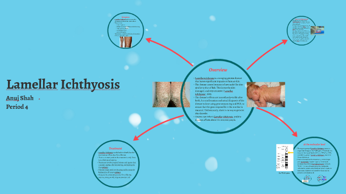 lamellar ichthyosis treatment