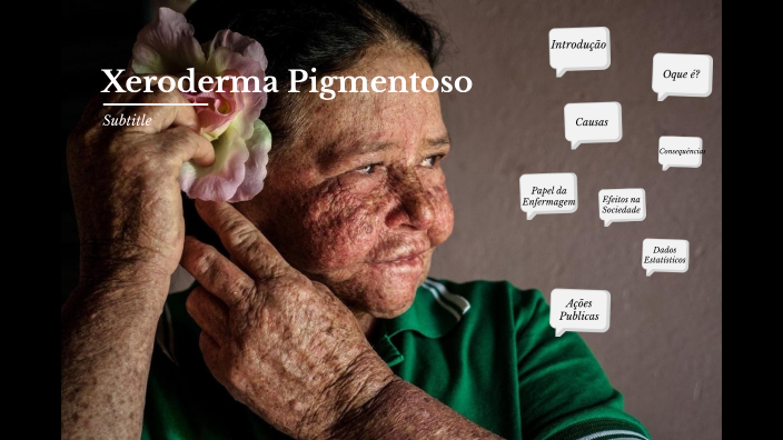 Xeroderma Pigmentoso by Juliana Medeiros Vieira on Prezi