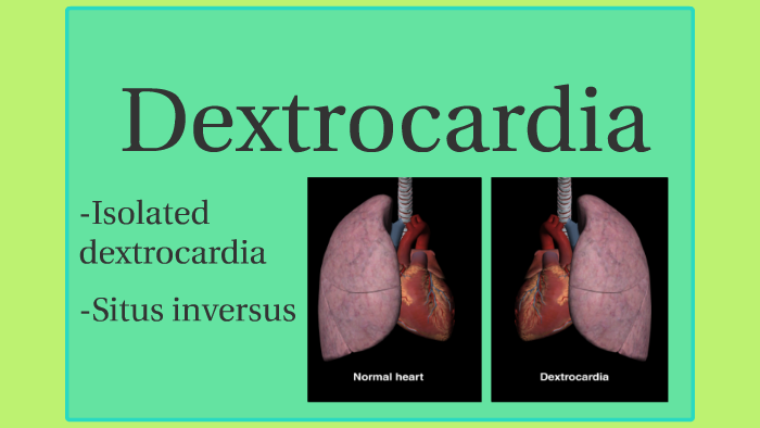 Dextrocardia By Kiran Kaur