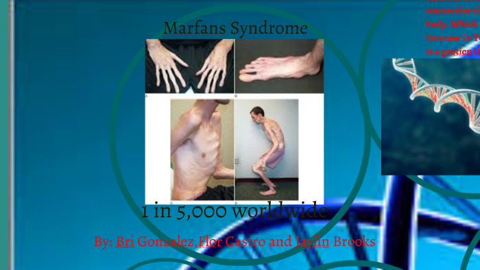 Marfans Syndrome By Bri Gonzalez On Prezi