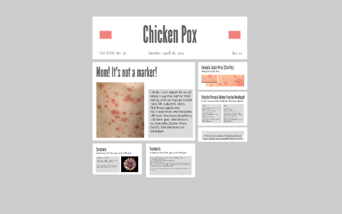 Chicken Pox by Mary Ingram on Prezi