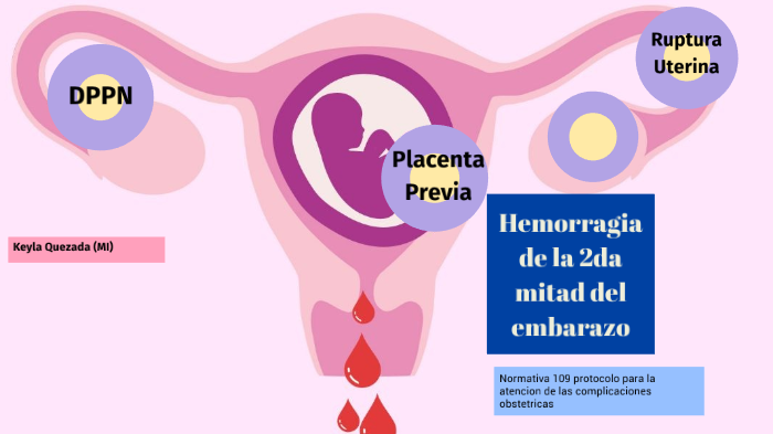 Hemorragia de la 2da mitad del embarazo by Kenia Lillieth Quezada  Valenzuela on Prezi Next