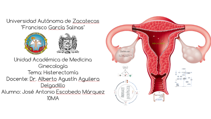 Es histerectomia medicina que en
