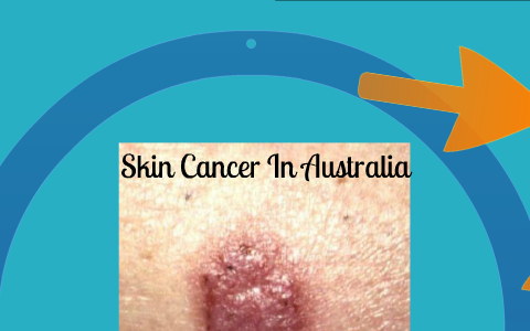 Skin Cancer In Australia by Chris and Callum on Prezi