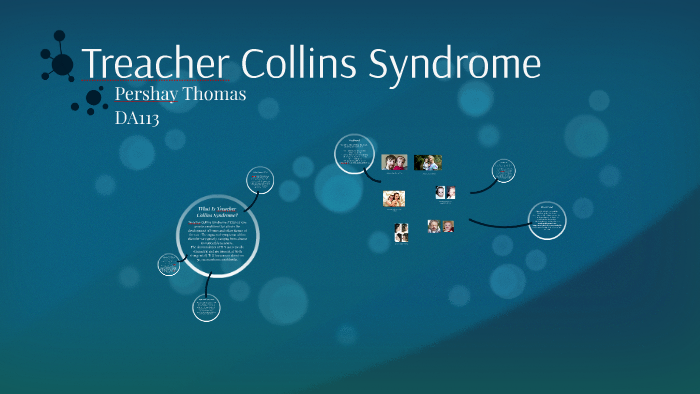 treacher collins syndrome infographic examples