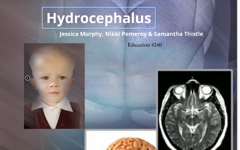 Hydrocephalus - Education 4240 By Jessica Murphy On Prezi