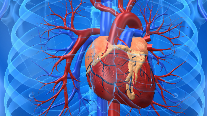 Vad är en hjärtinfarkt? by Isabelle Forslund