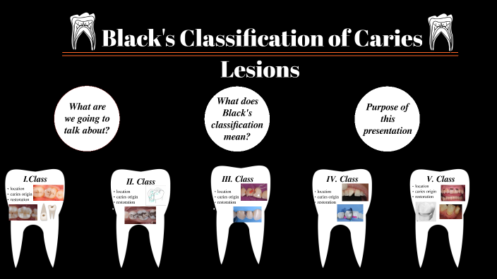 Blacks Classification Of Caries Lesions By Emma Schmidtová On Prezi 5623