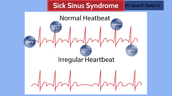 Sick Sinus Syndrome by Lance Ponsaran