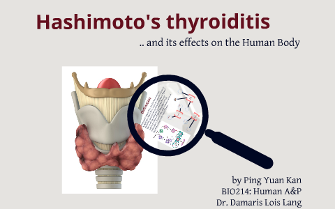 Hashimoto's Disease, or Chronic lymphocytic thyroiditis by Ping Kan