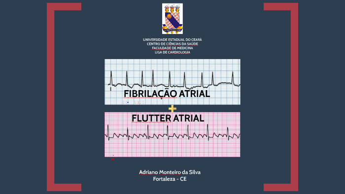 Fibrilação atrial e Flutter atrial by Adriano Monteiro on Prezi