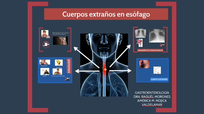 Cuerpos extraños en esófago by América Mojica Valdelamar on Prezi