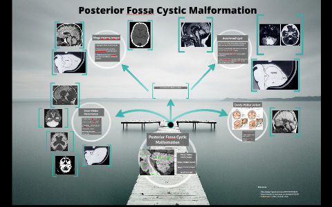 Posterior Fossa Cystic Malformation by kate pimentel on Prezi