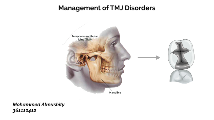 Management Of TMJ Disorder By Mohammed Almushity On Prezi