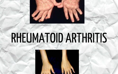 Rheumatoid Arthritis by Mariah Pierce