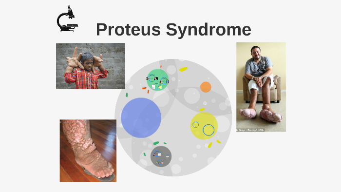 icd 10 proteus syndrome