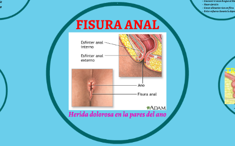 Fisura interna en el ano