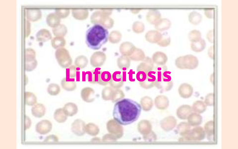 Linfocitosis by alejandra herrera on Prezi