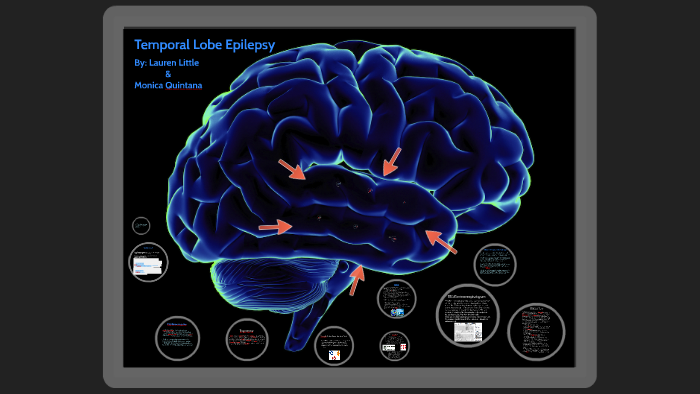 Bipolar Disorder Temporal Lobe Epilepsy – MPMZP