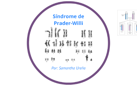 Karyotype of Prader-Willi Syndrome by Samantha Urena on Prezi