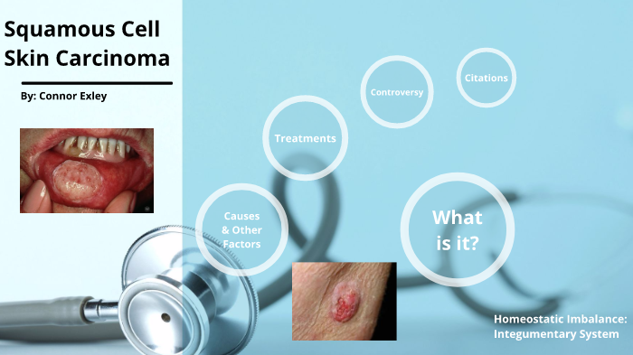 Squamous Cell Skin Carcinoma by Connor Exley on Prezi