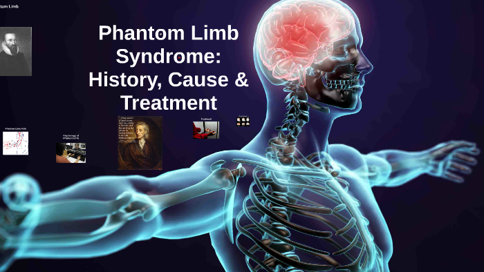 phantom-limb-syndrome-perception-cause-treatment-by-hui-xin-e-chen