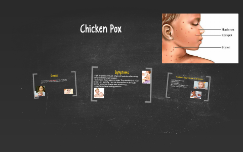 Chicken Pox by Ian Borman on Prezi