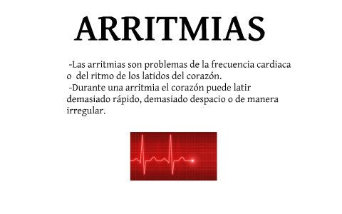 Arritmia y Marcapasos. by Lisandro Iatzky