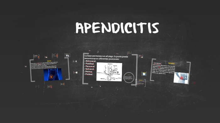 APENDICITIS by Aida Berganza on Prezi