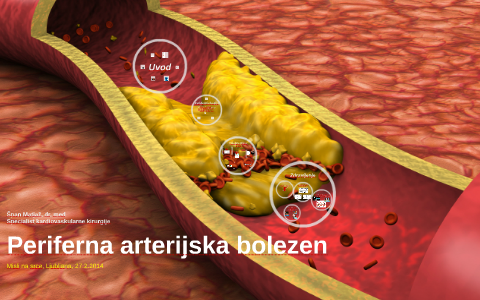 Periferna arterijska bolezen by