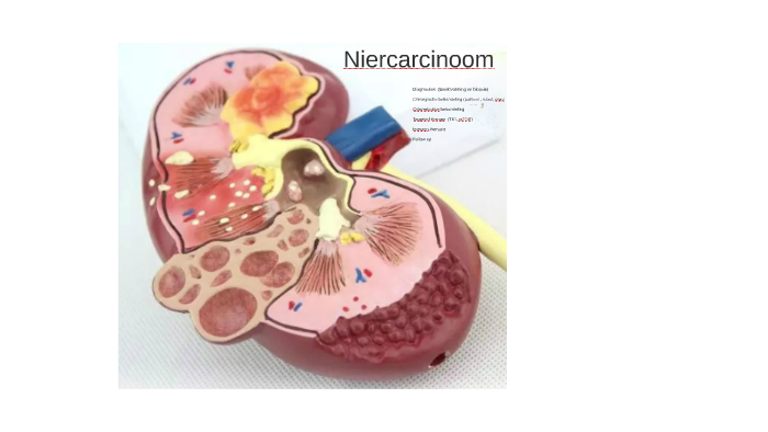 Niercelcarcinoom By Sajjad Rahnama i On Prezi niercelcarcinoom-by-sajjad-rahnama-i-on-prezi