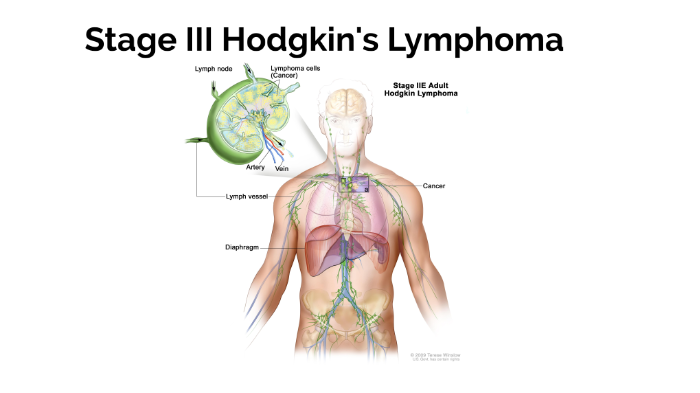 Stage III Hodgkin's Lymphoma by chesicka johnson on Prezi