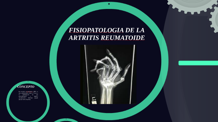 FISIOPATOLOGIA DE LA ARTRITIS REUMATOIDE by Karla Alexandra Arteaga ...