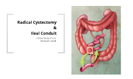 Copy Of Radical Cystectomy With Ileal Conduit By Douglas Ferrall On Prezi